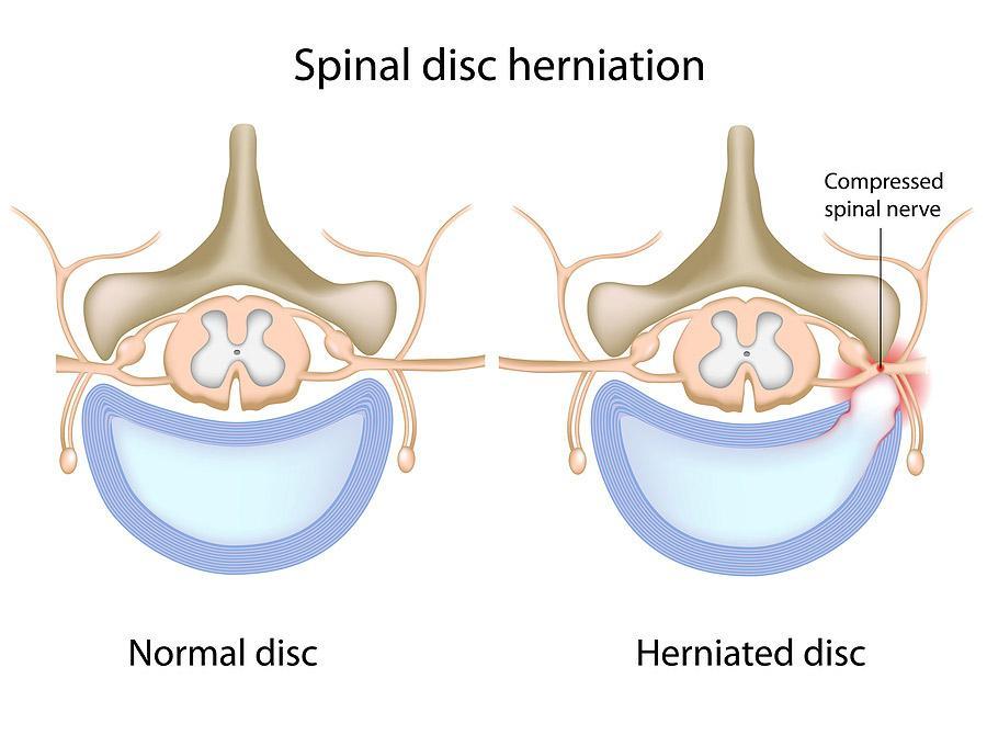 Spinal Disk Herniation Infographic