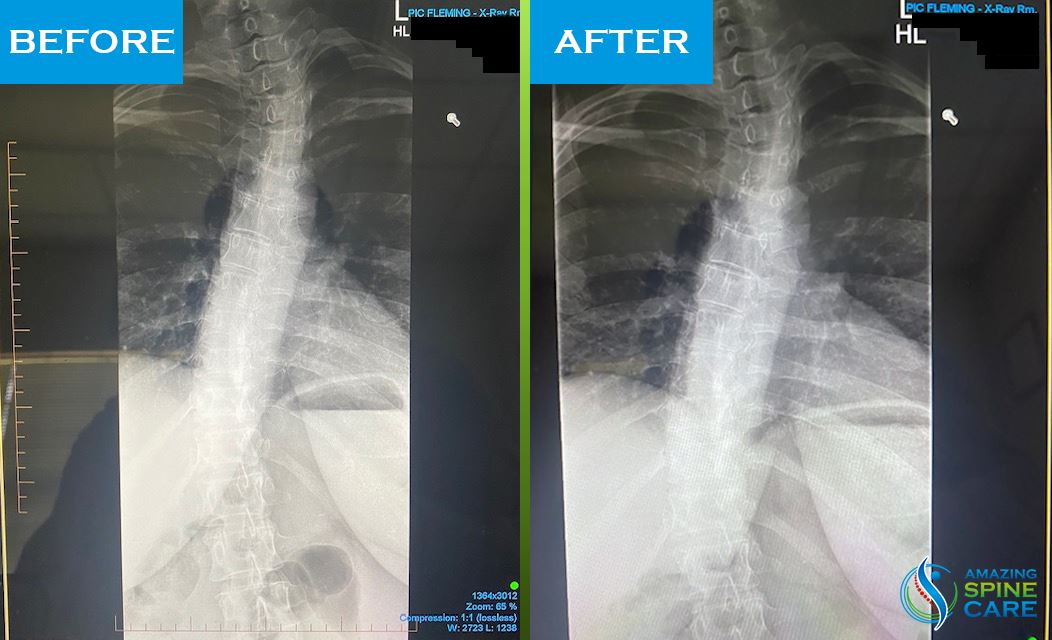 Spine X-Ray 